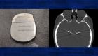 The new device (left) acts like a pacemaker that can adjust the parameters of stimulation automatically. The CT scan (right) shows the placement of four electrodes to deliver the stimulation.
