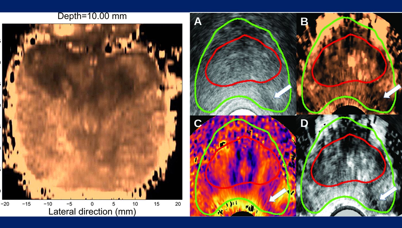 The image on the right shows how brightiness can help identify specific regions of the prostate. The image on the right shows how imaging modalities including B-mode (figure A), ARFI (B), SWEI (C), and mpUS (D), demonstate structural consistency. The capsule (green) and central gland (red) are identified along with a suspicious region (white arrow). 