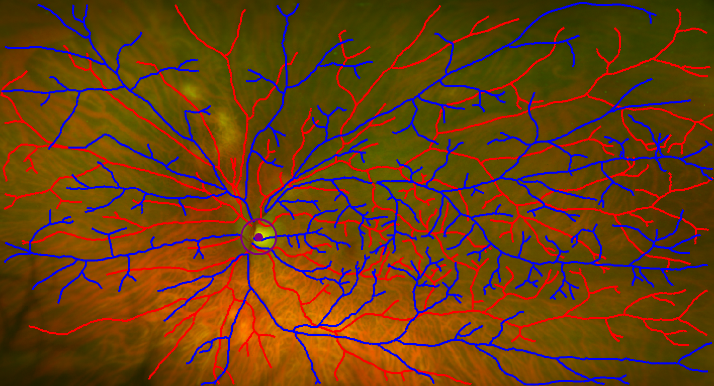 The image shows the arteries and veins distinguished in the eye