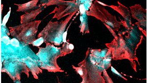 Fluorescent microscopy image showing robust uptake of SARS-CoV-2 by human stem cell-derived kidney podocytes. The infected cells express viral nucleocapsid protein (Red) and the podocyte cell lineage identification marker, nephrin (Cyan) 
