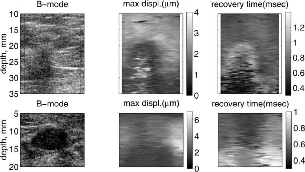 The graphic shows scans of two different breast masses. The top row shows a malignant mass, and it creates a clearer boundary in the ARFI displacement image on the far right. The bottom row shows a benign breast mass, which doesn't create a boundary in the final ARFI image. 