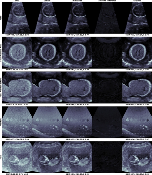 MimicNet is able to use artifical intelligence to identify and remove speckle and other artifacts from ultrasound images, creating final results that are nearly as clear as clinical images from high-tech systems. 