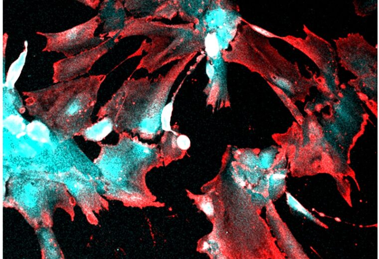 Fluorescent microscopy image showing robust uptake of SARS-CoV-2 by human stem cell-derived kidney podocytes. The infected cells express viral nucleocapsid protein (Red) and the podocyte cell lineage identification marker, nephrin (Cyan)