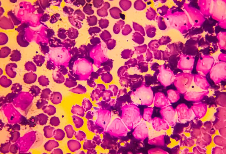 Bone marrow aspirate cytology of multiple myeloma, a type of bone marrow cancer of malignant plasma cells
